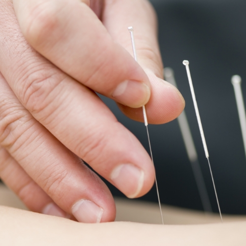 physical-therapy-clinic-dry-needling-peak-physical-therapy-&-sports-rehabilitation-michael-commons-williamsburg-va